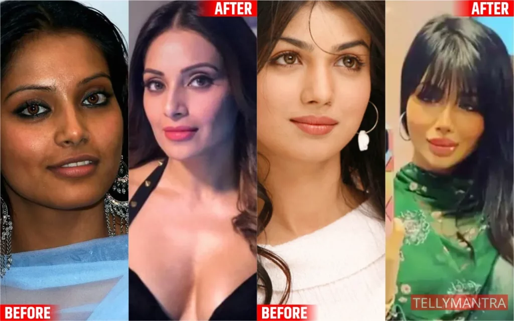 Bollywood Actresses before and after plastic surgery