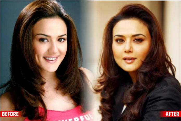 Priety ZintaThe Btown Actresses Before and After Plastic Surgery